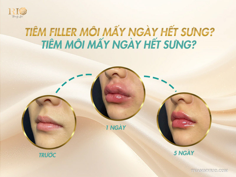 Quá trình hồi phục chi tiết của tình trạng tiêm môi bị sưng qua từng ngày.