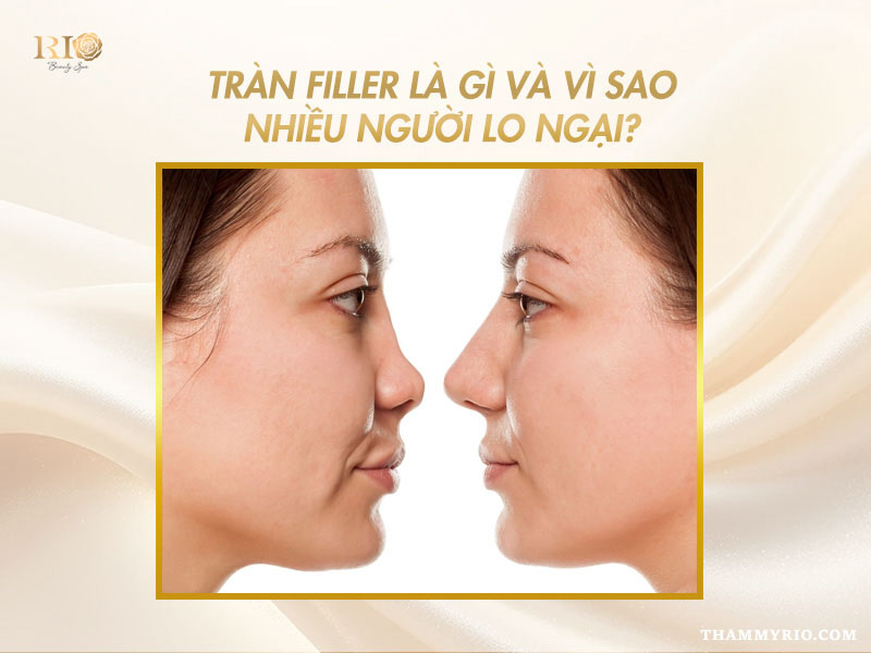 Góc nhìn nghiêng giải thích tràn filler vì sao khiến nhiều người lo ngại.
