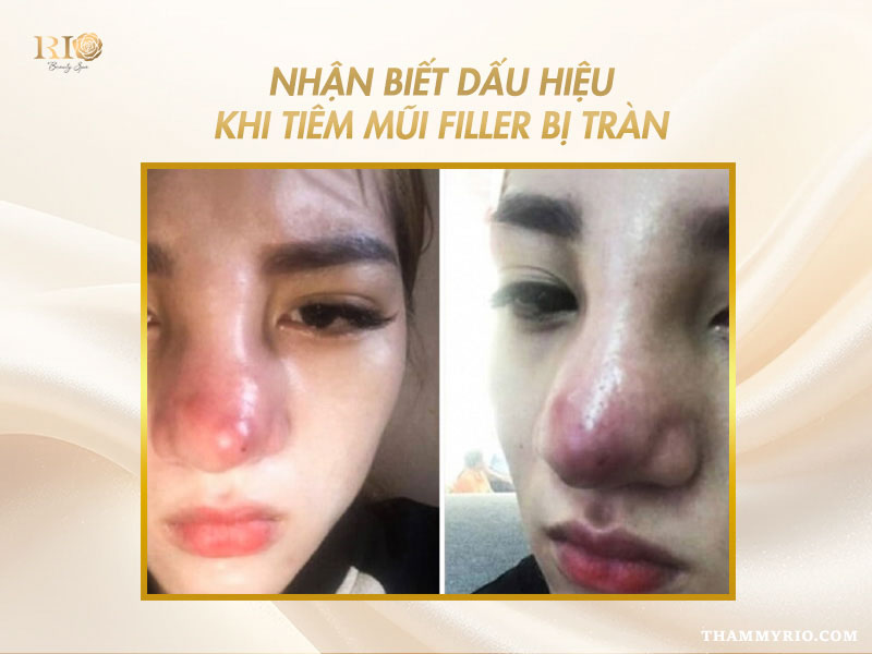 Biểu hiện sưng đỏ nhận biết tiêm mũi bị tràn filler.