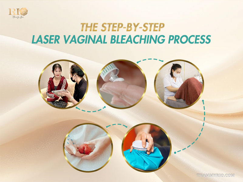 The step-by-step laser vaginal bleaching process at Rio Beauty Clinic.