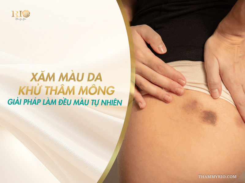 Vùng mông bị thâm sạm trước khi thực hiện xăm màu da khử thâm mông làm đều màu tự nhiên