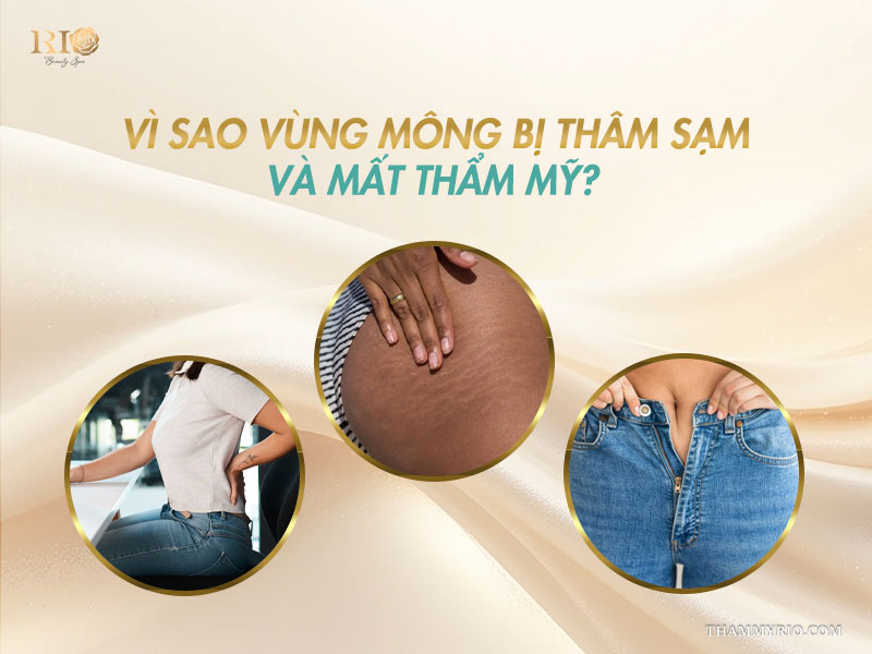 Các nguyên nhân gây thâm sạm vùng mông cần can thiệp xăm màu da khử thâm mông