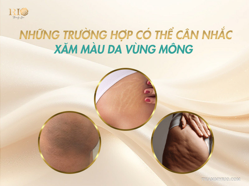 Tình trạng vết rạn, thâm chai sần và sần vỏ cam phù hợp làm xăm màu da khử thâm mông