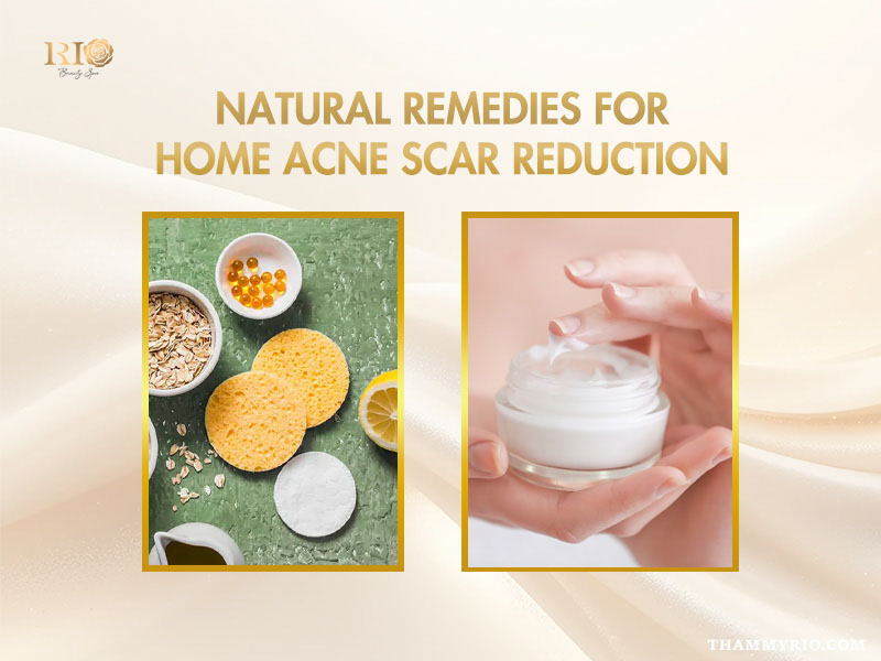 Natural ingredients and cream for home acne scar treatment