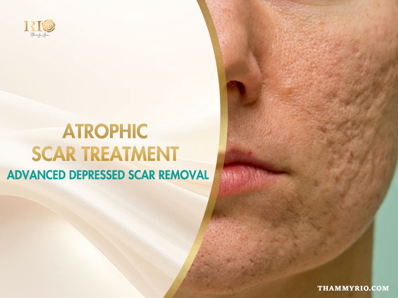 Face with indented scars for professional atrophic scar treatment
