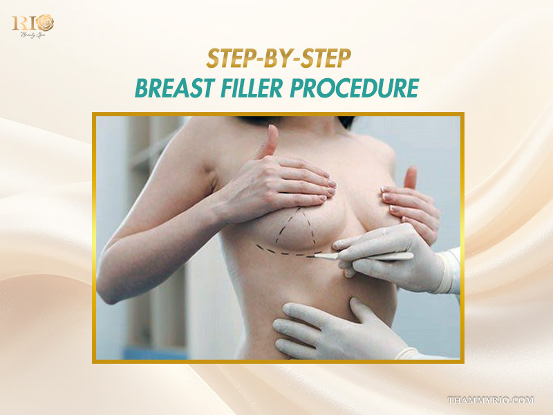 Medical specialist mapping out steps for a safe breast filler procedure.