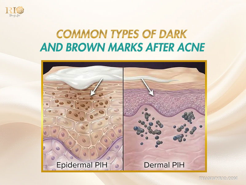 Epidermal and dermal pigmentation stages for dark scar treatment
