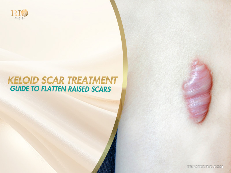 Keloid scar treatment guide to flatten raised scars on skin