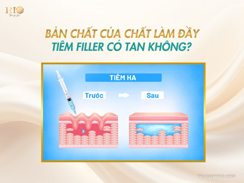 Bản chất của chất làm đầy giải thích cho việc tiêm filler 2 năm không tan.
