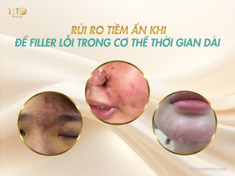 Cảnh báo rủi ro tiềm ẩn từ việc tiêm filler 2 năm không tan.