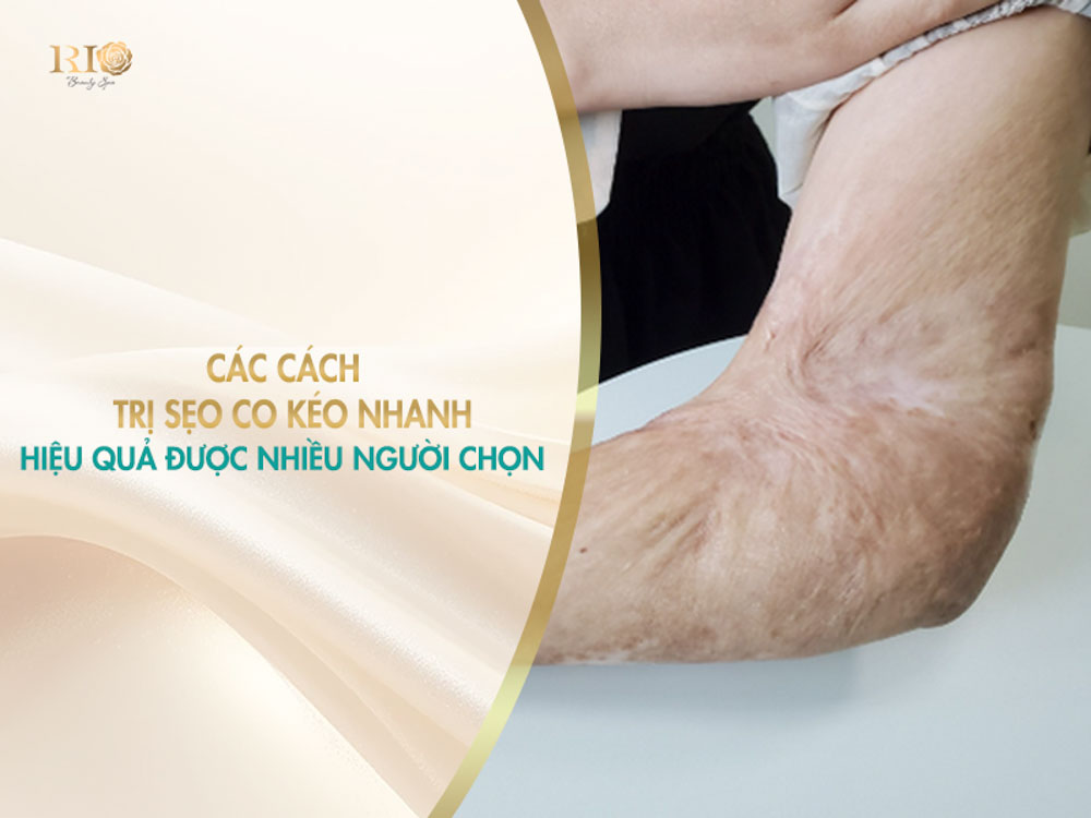 các cách trị sẹo co kéo nhanh hiệu quả được nhiều người chọn