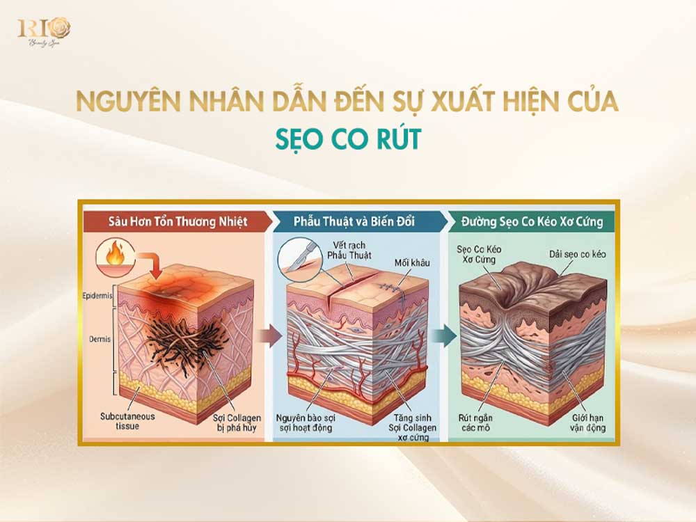 nguyên nhân hình thành tổn thương da cần trị sẹo co kéo