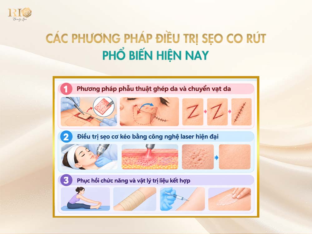 các phương pháp phổ biến được ứng dụng trong trị sẹo co kéo