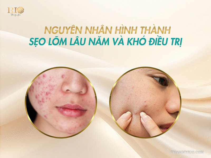 Nguyên nhân khó trị sẹo lõm lâu năm