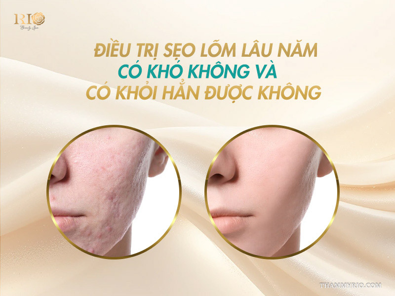 Hiệu quả trị sẹo lõm lâu năm