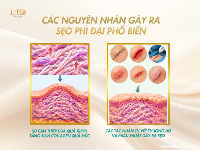 Nguyên nhân vết thương gây ra để trị sẹo phì đại