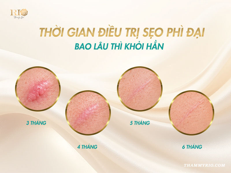 Tiến trình thời gian trị sẹo phì đại qua các tháng