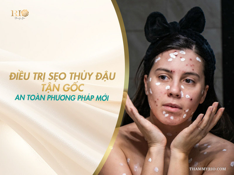 Làn da bị mụn nước và thâm sẹo cần áp dụng trị sẹo thủy đậu kịp thời.